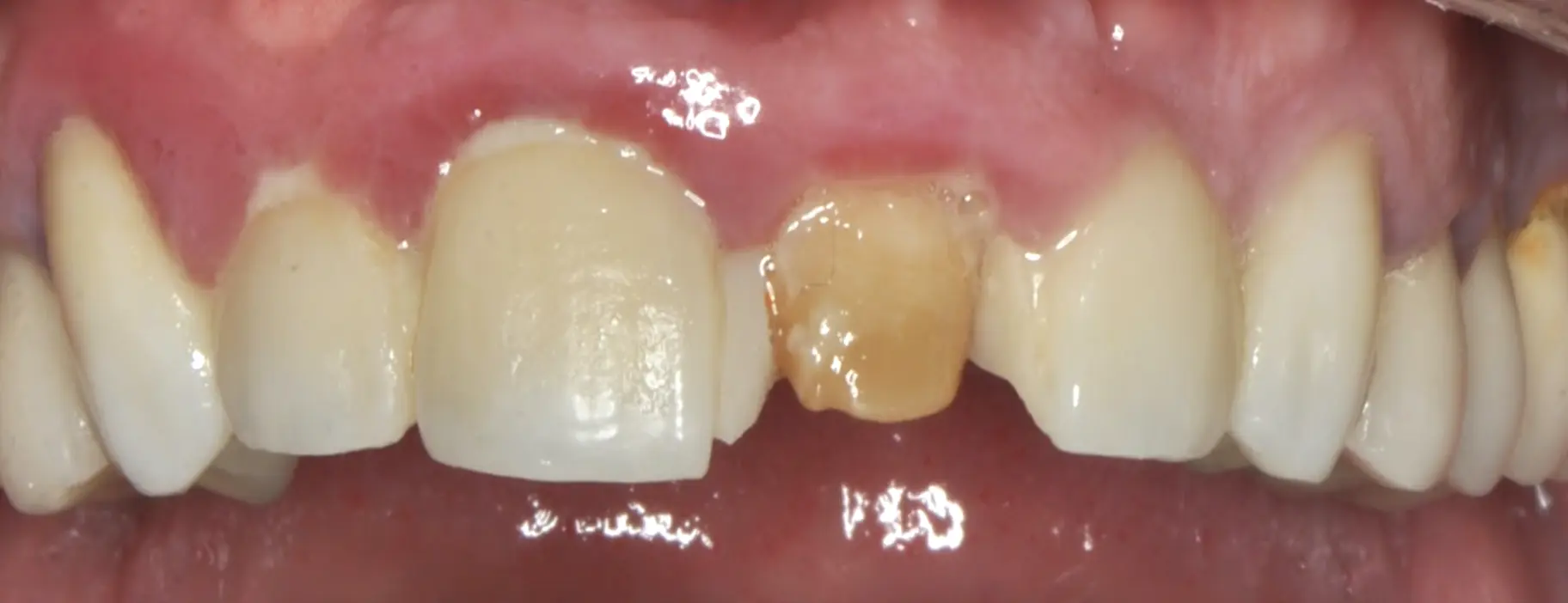 Temporary crowns on frontal teeth, changing old composite restorations (before and after)