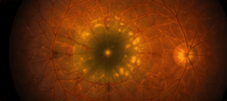 senile macular degeneration