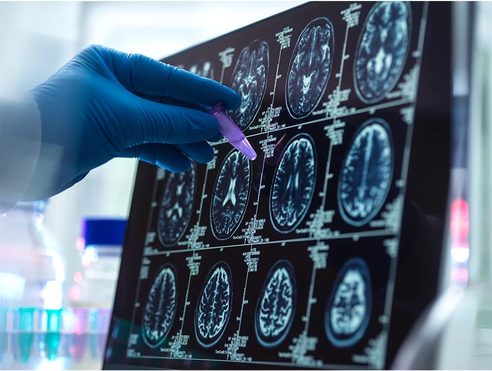 Medical professional analyzing neurological imaging results with vial in hand