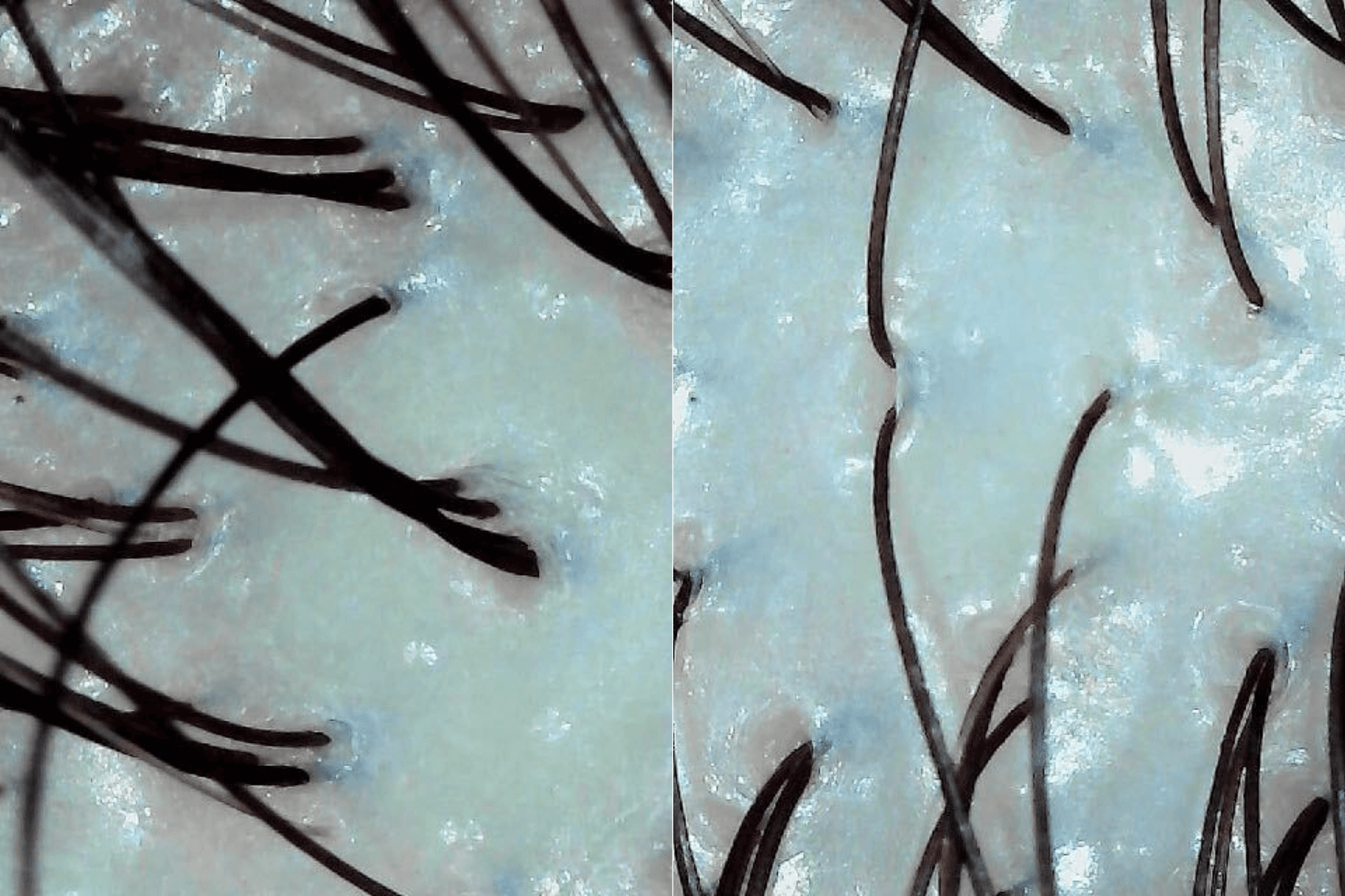 Microscopic close-up of oily scalp buildup on head of client after treatment