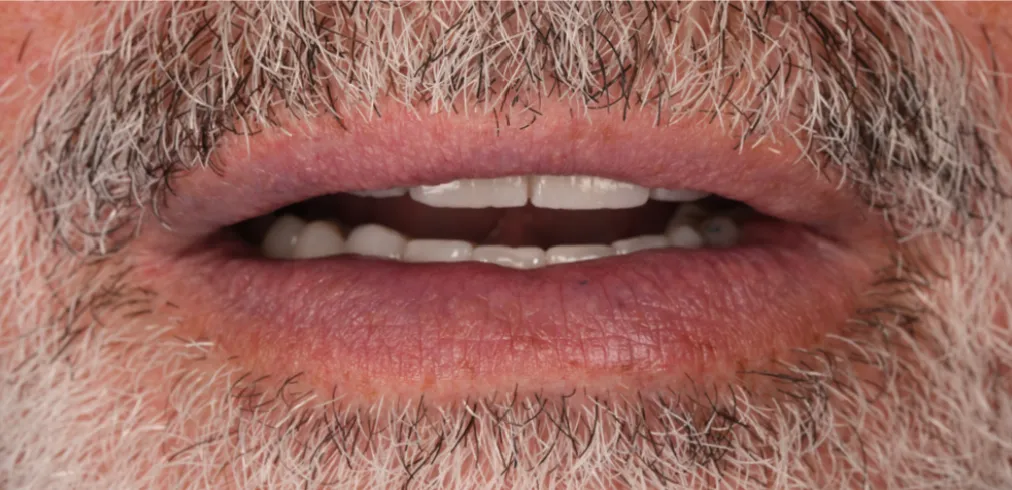 After prosthetic rehabilitation