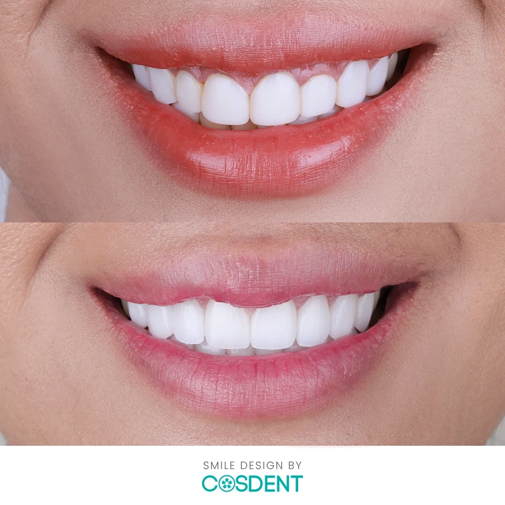 รีวิวออกแบบรอยยิ้ม ที่ cosdent smile design