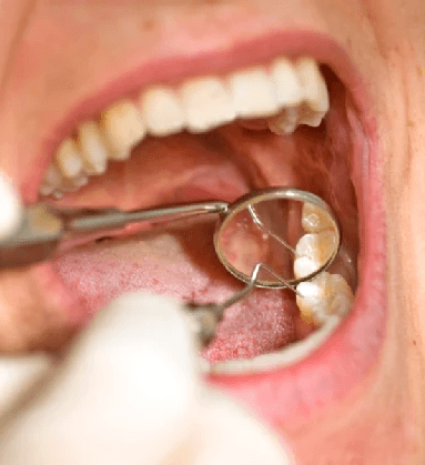 Root Canal Rochelle Park