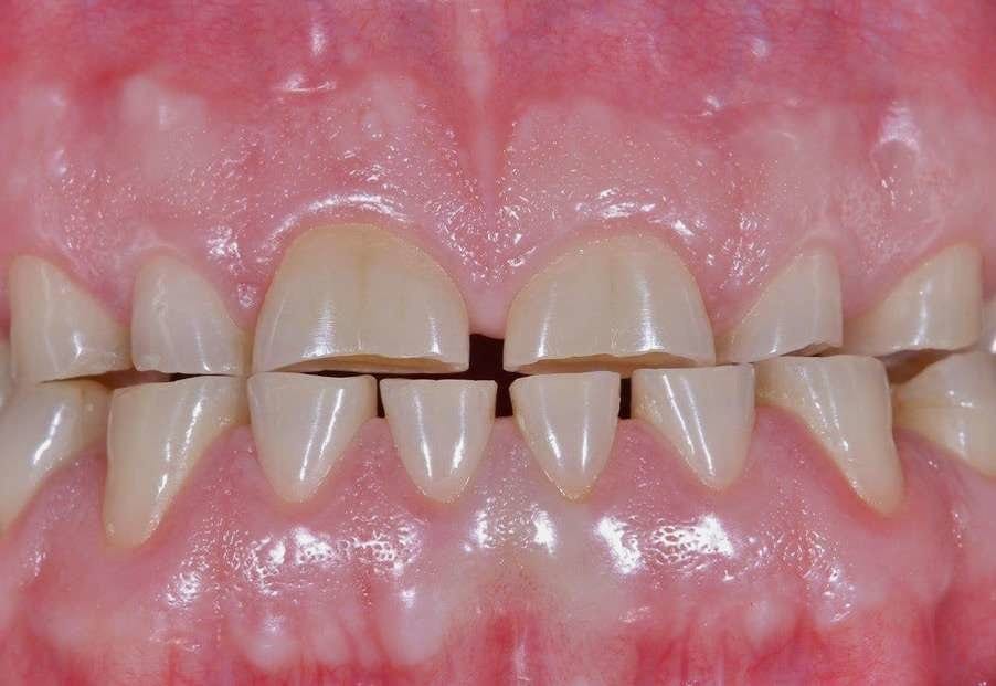 full mouth rehabilitation