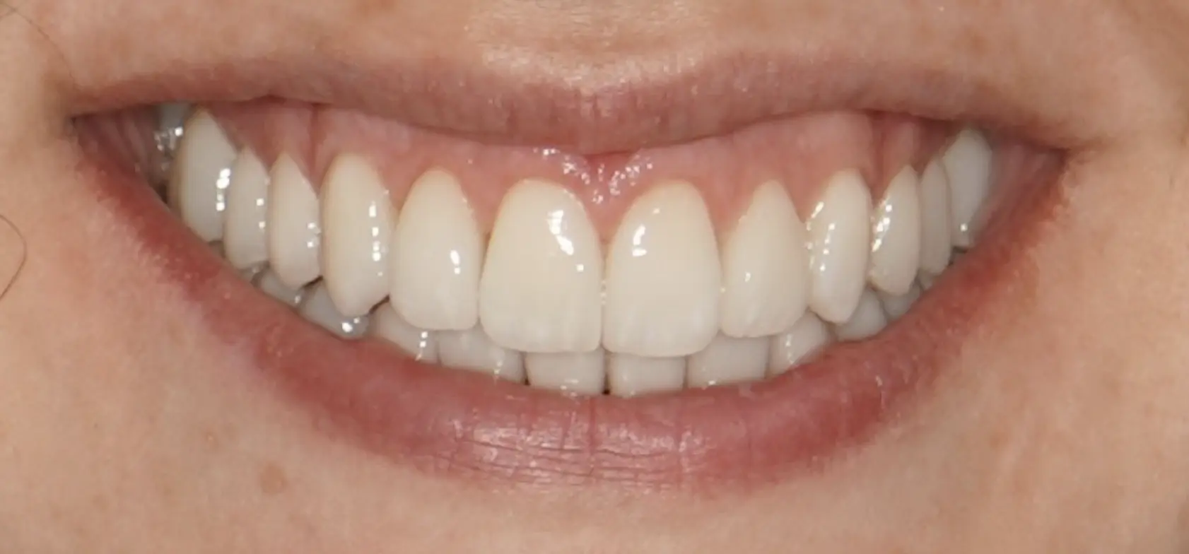 Before and after definitive ceramic restorations (crowns, veneers)