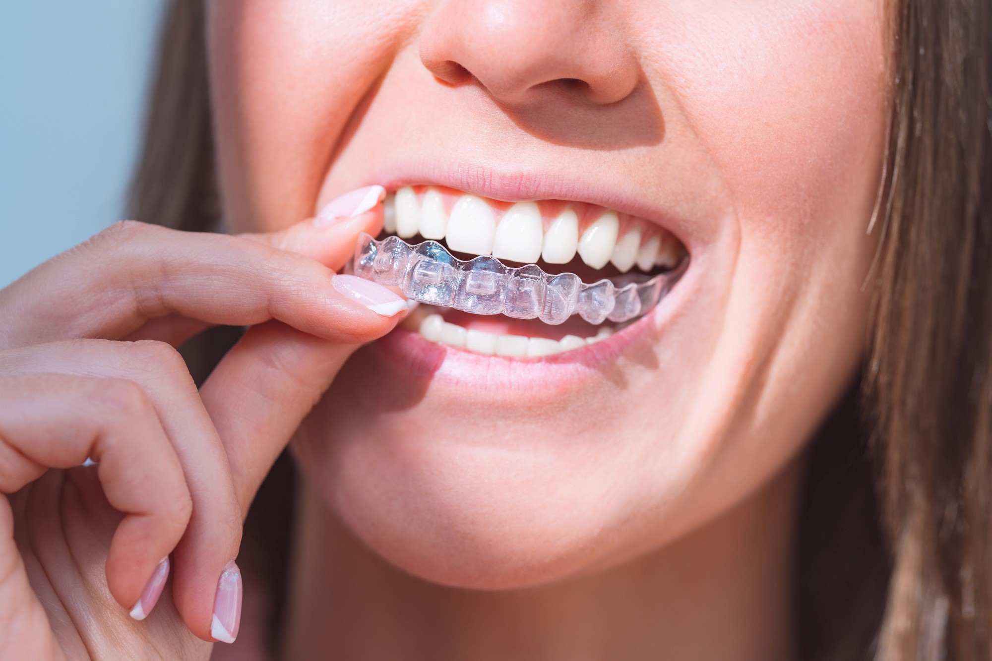 Invisalign Clear Aligners
