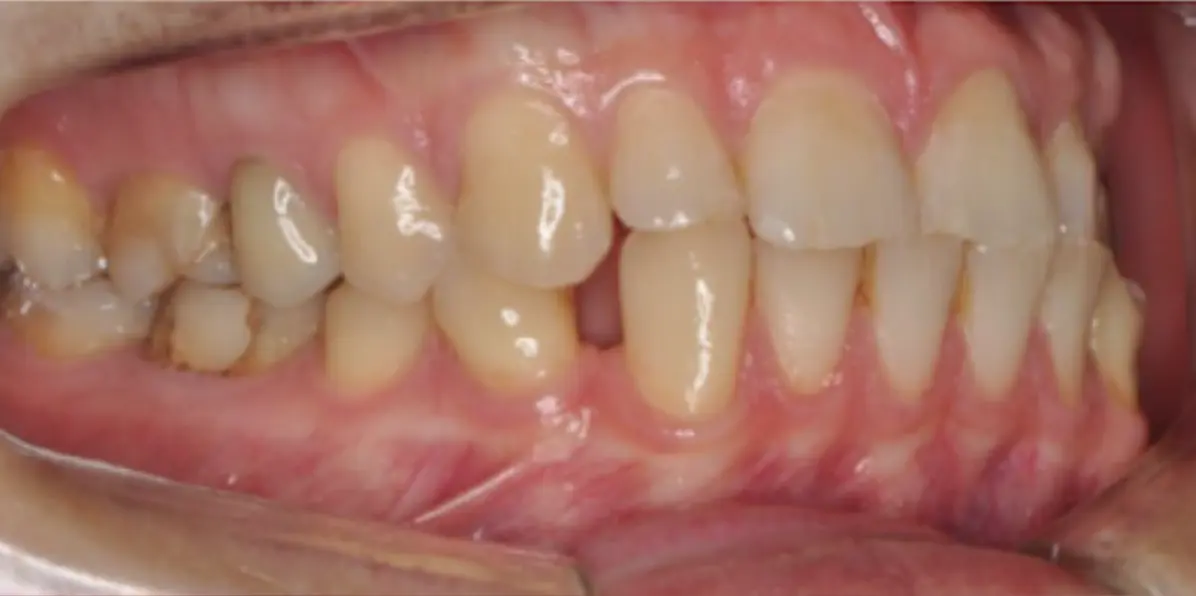 Prima e dopo il trattamento ortodontico funzionale, senza estrazione dei denti premolari