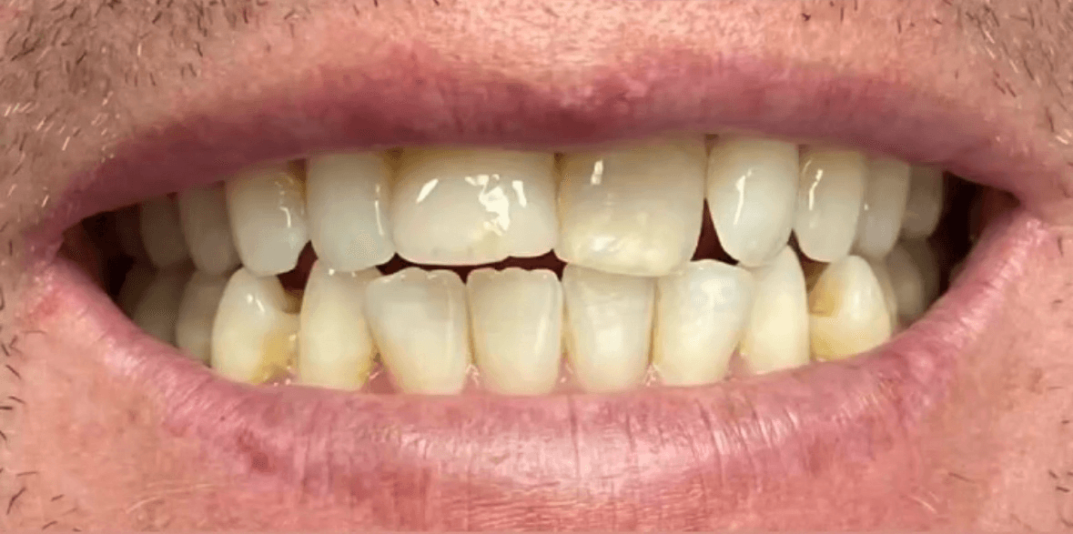 Crowns + Veneers, Smile redesign, Full restoration - before treatment