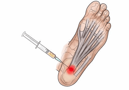 Illustration of Steroid Injection for Foot & Ankle