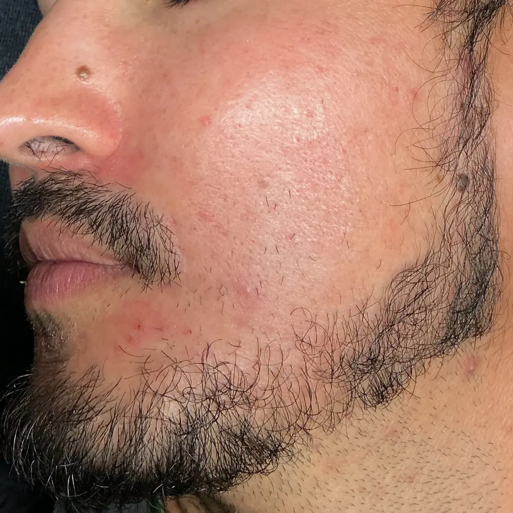 Before men's facial at The Vancouver Aesthetician — visible beard area irritation, redness and clogged pores on men's skin