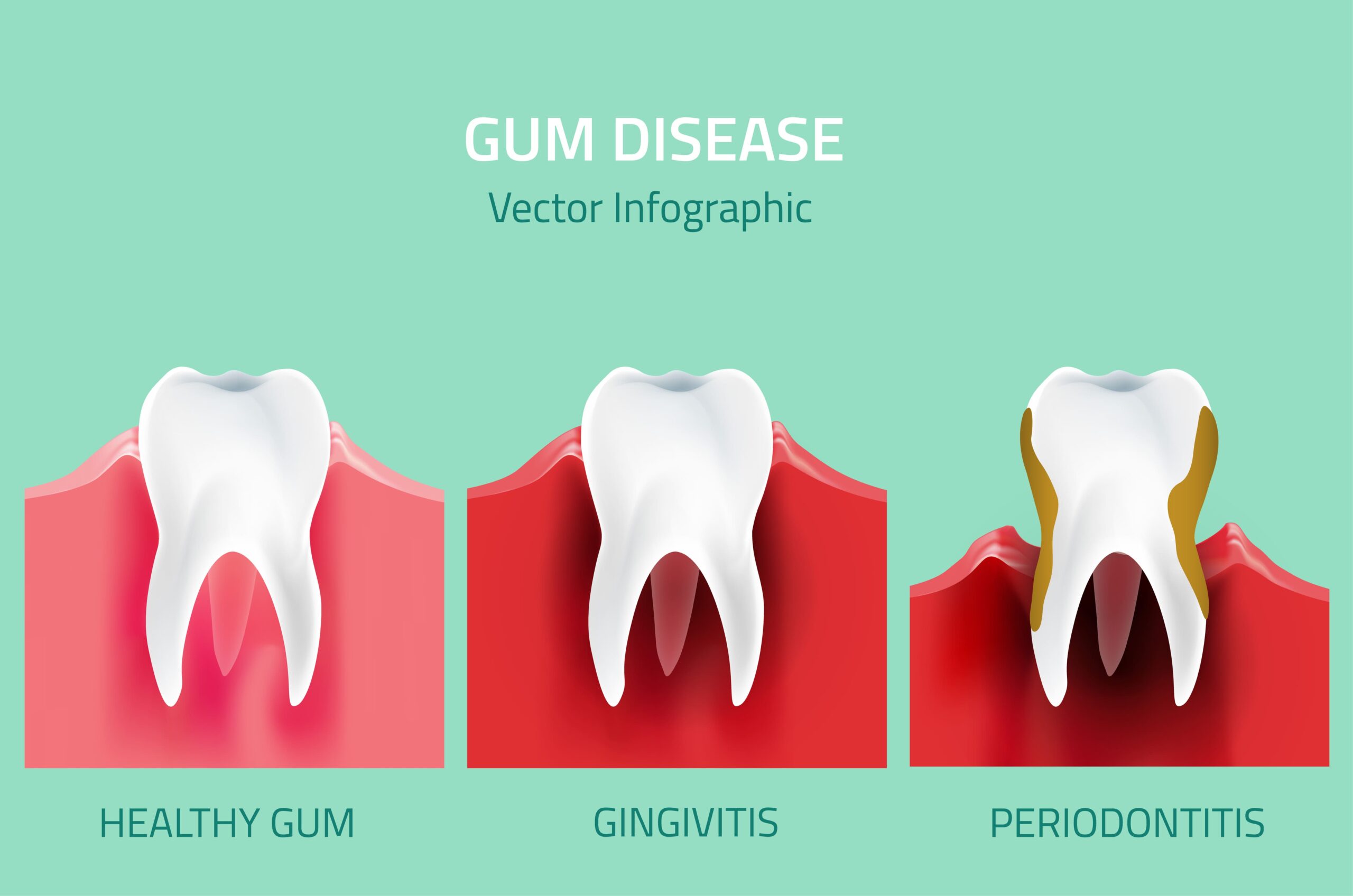 Periodontal Disease Stages
