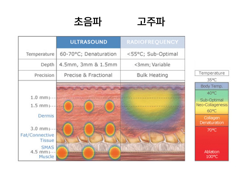 ultrasound and radiofrequency comparison chart 