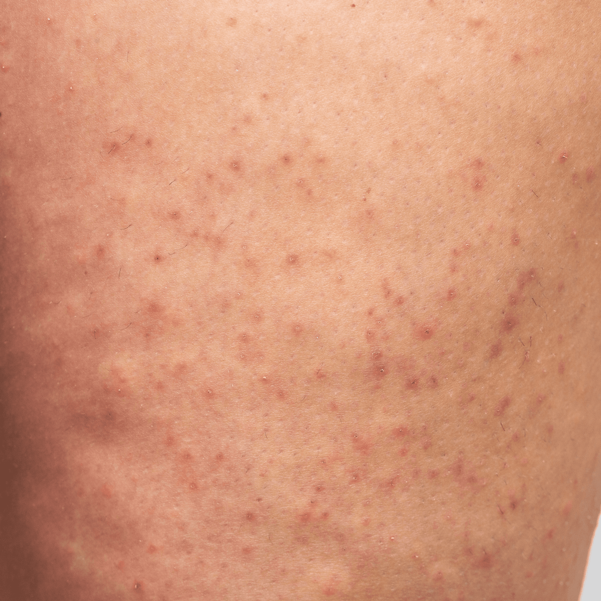 Seborrhoische Keratose