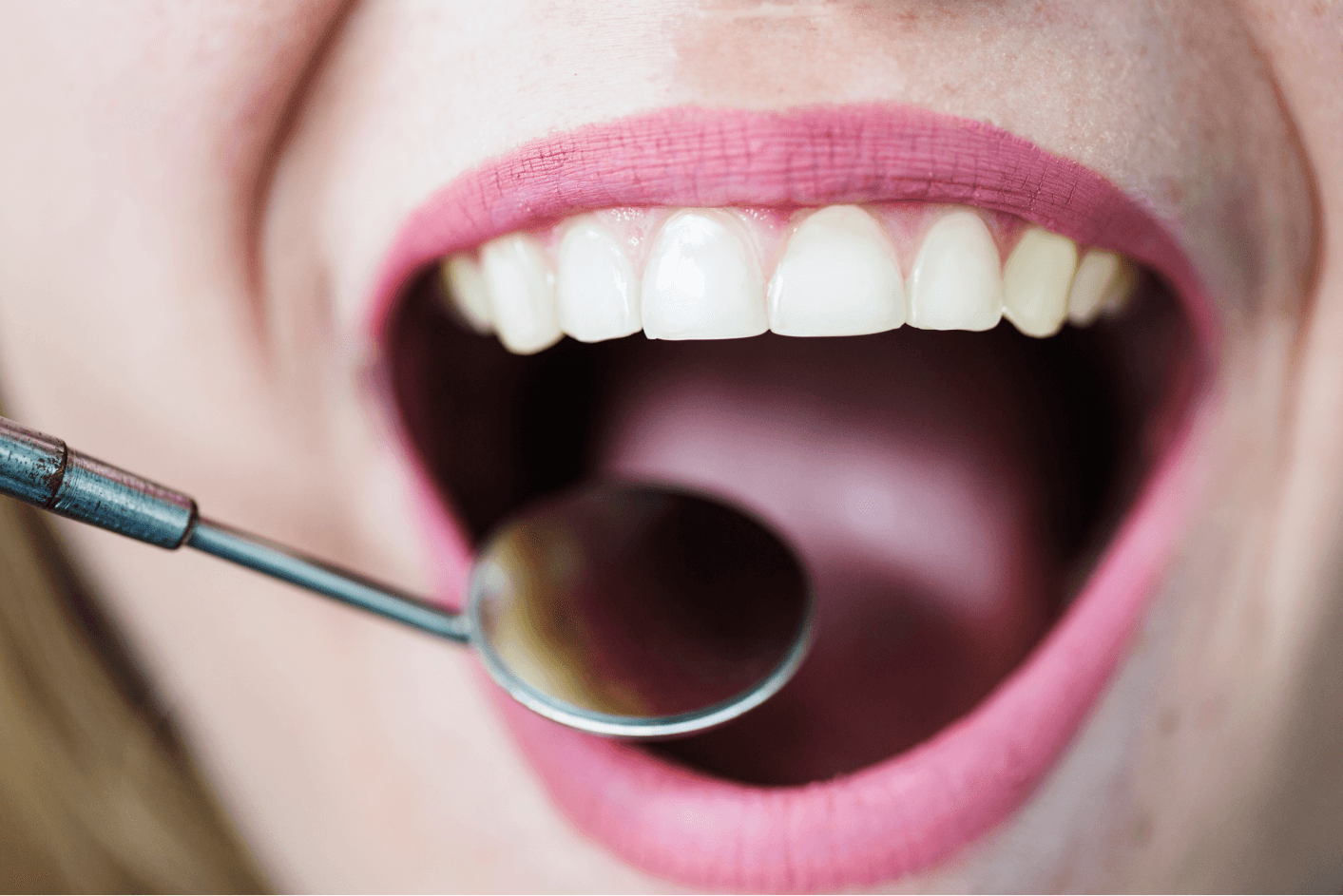 A close-up of a mouth with severely discolored or stained teeth being examined with a dental mirror.