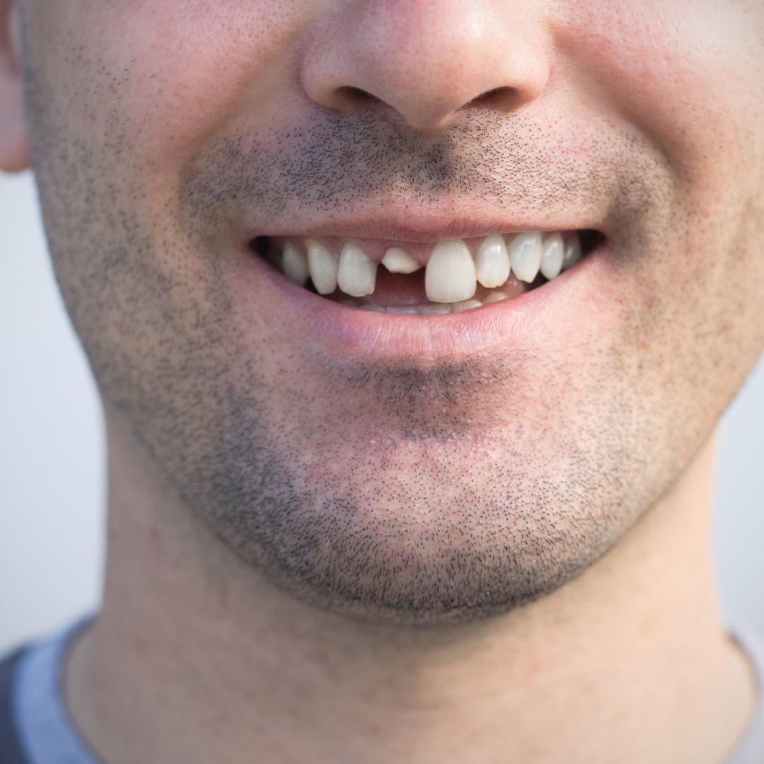 Cosmetic correction of gapped teeth at Dentistree Kolkata for improved smile aesthetics.