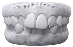 Crowding teeth
