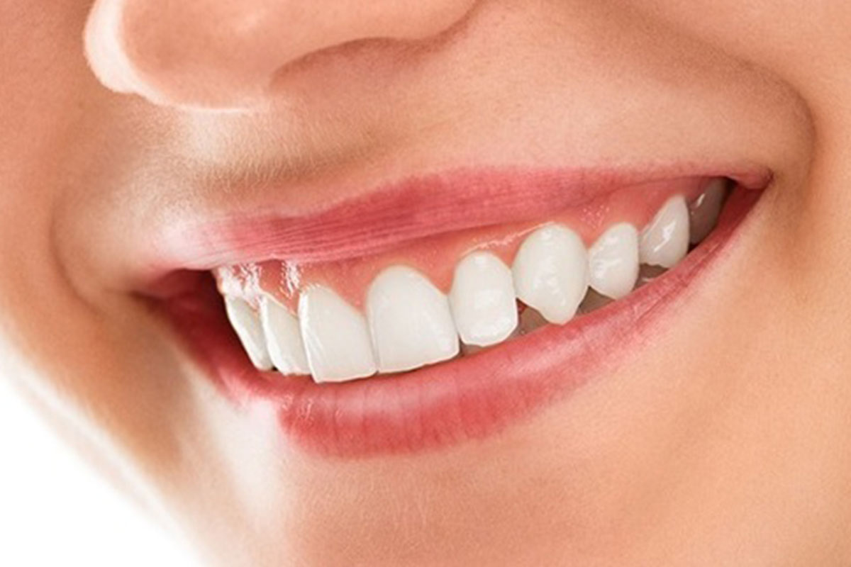 smile makeover