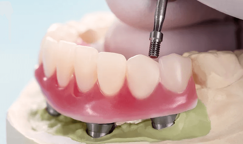all-on-4 dental implants
