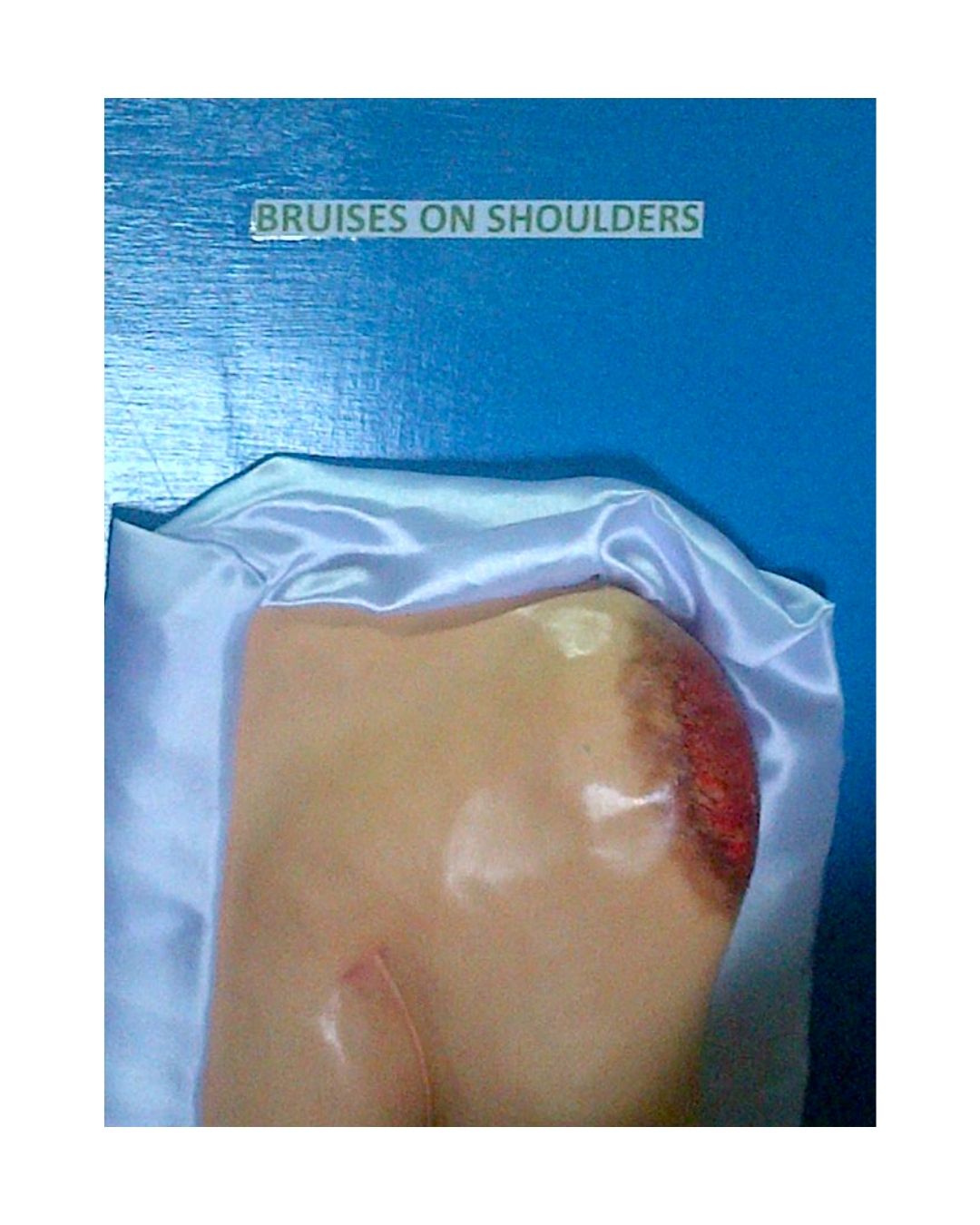 Bruises on Shoulders