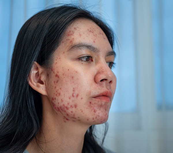 Woman with severe acne on her cheeks and jawline, showing extensive red, inflamed lesions