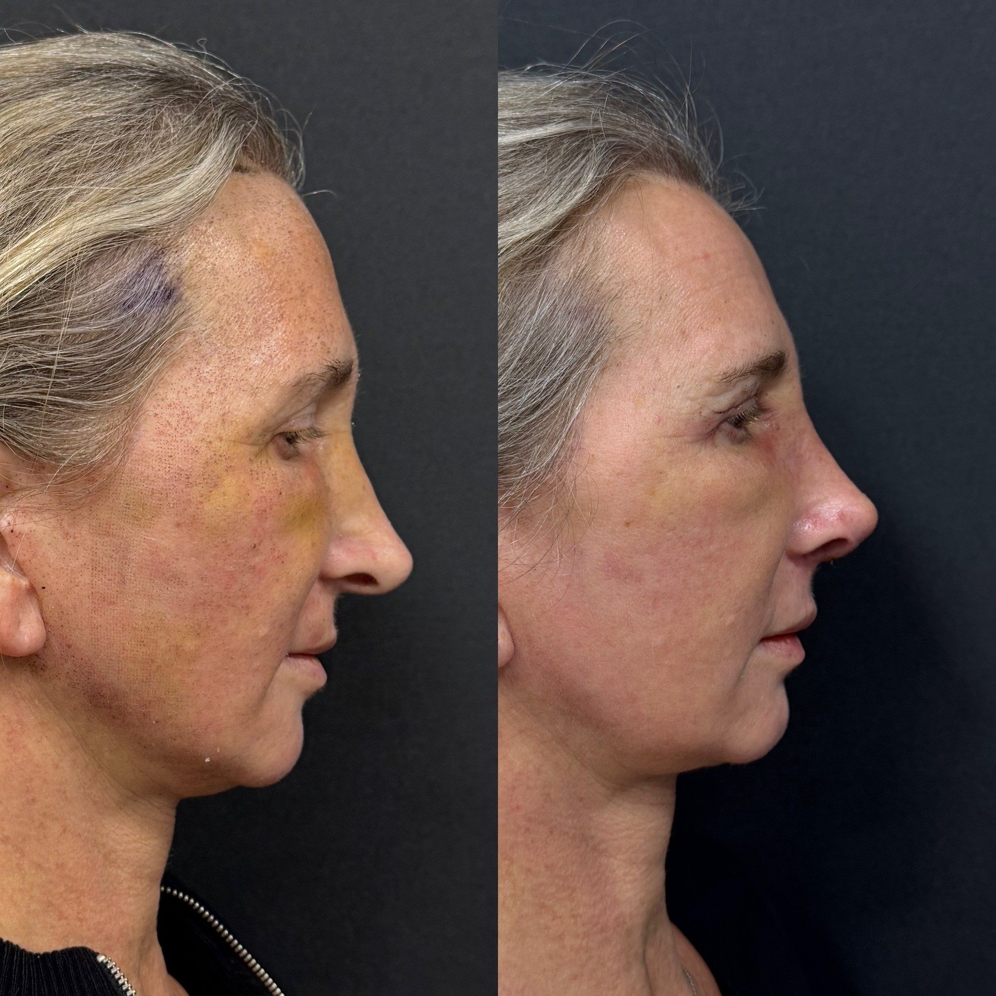 revision rhinoplasty deviation fixed before after 5 days post-op left side view