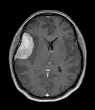 Imagen anatómica de un meningioma