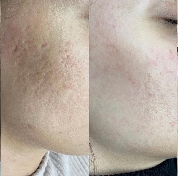 Laser treatment on woman's cheek with protective eye shield