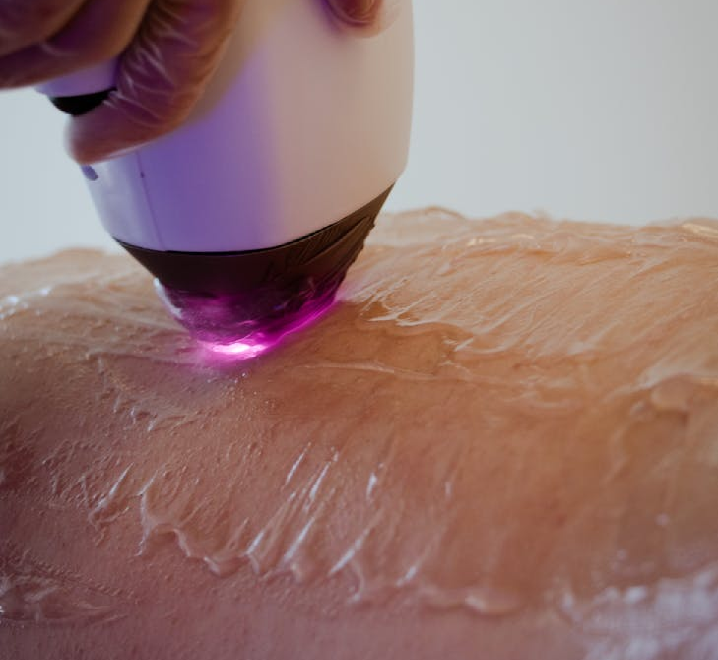 Laser hair removal treatment on a patient's back.
