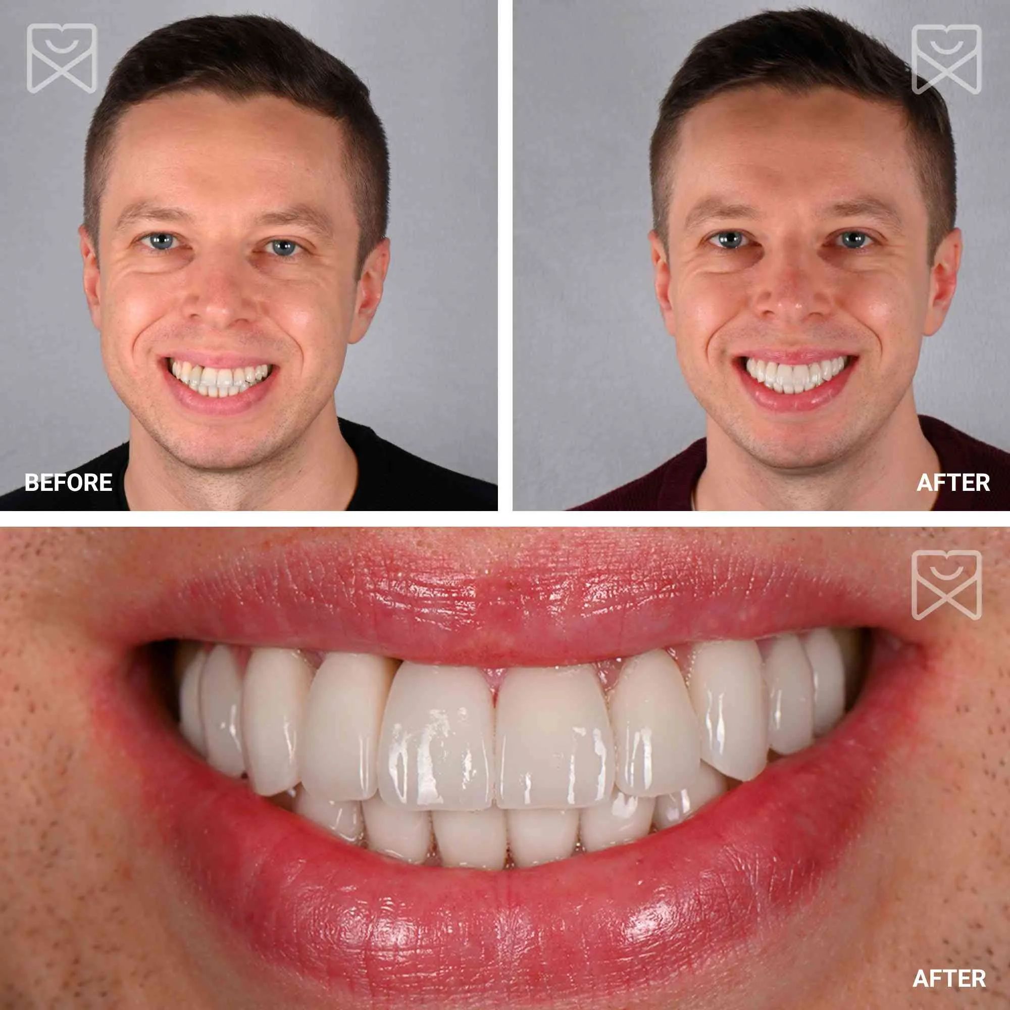 Smile makeover before and after transformation cosmetic dentistry