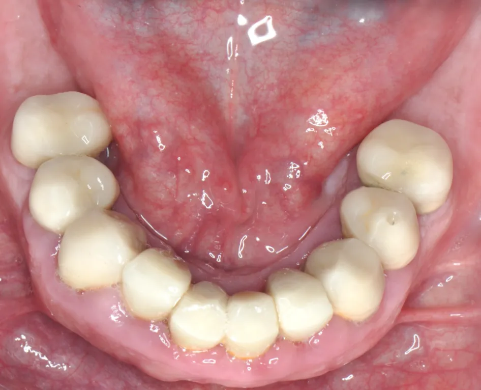 &nbsp;&nbsp;Before ortho treatment