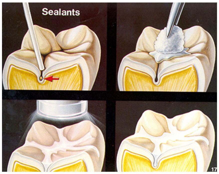 Illustration showing dental sealants applied on molar teeth to prevent cavities at Dentistree Kolkata.