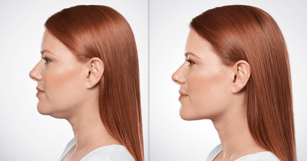 What Is Deoxycholic Acid Injection and How Is It Used in Aesthetic Clinics?