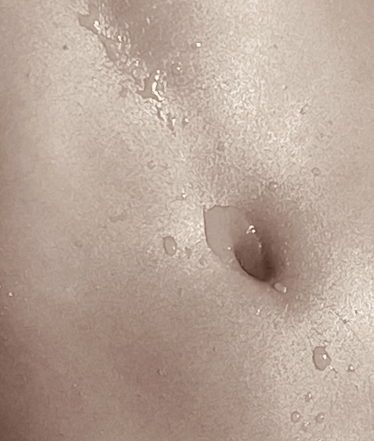 Hautstraffung und Kollagenboost Bauch mit Thermage FLX Bad Wörishofen Allgäu