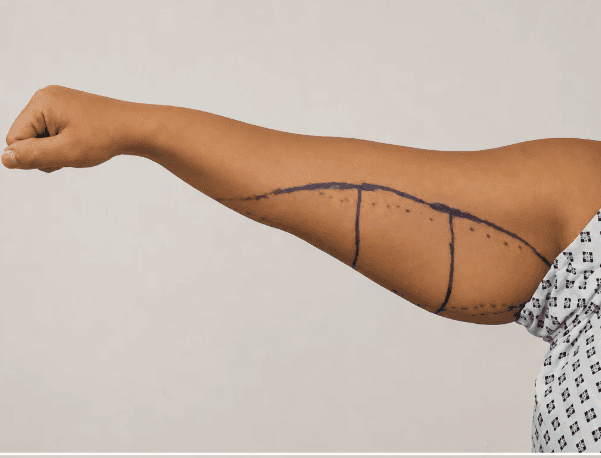 Woman with upper arms raised