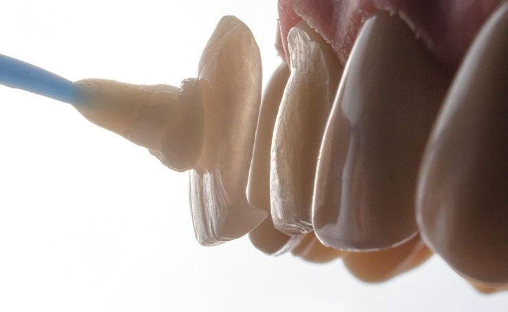 important Things to Know Before Getting Dental Veneers