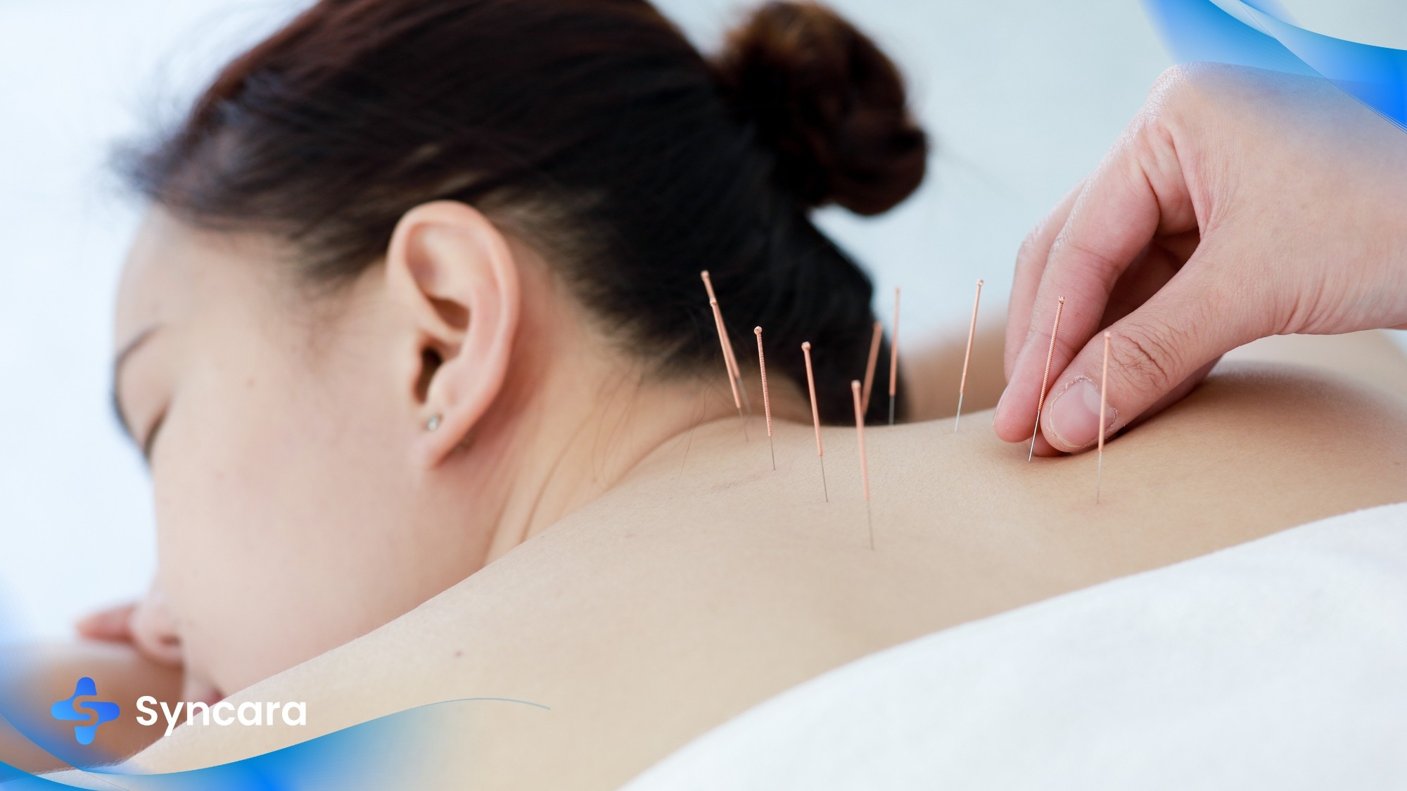 Professional acupuncture treatment in Mississauga clinic