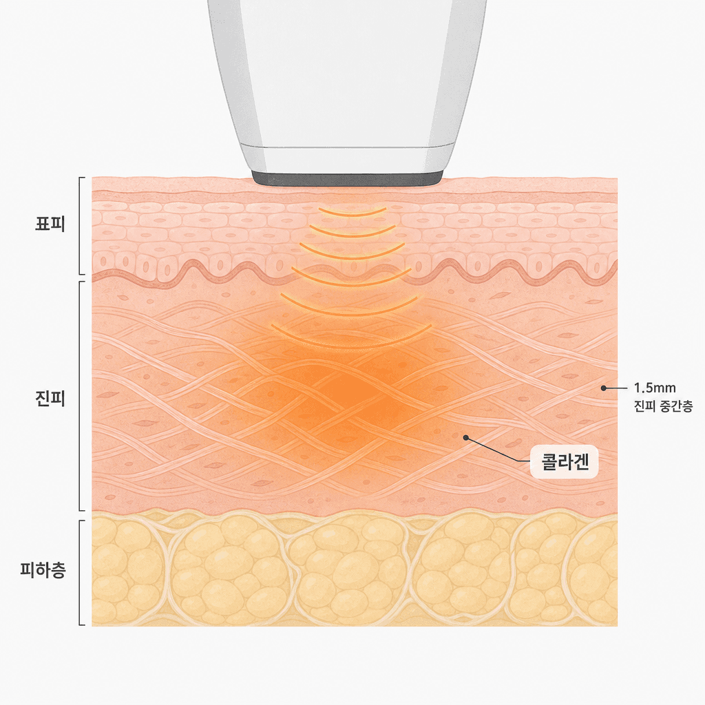 고주파 열이 닿는 진피층과 콜라겐