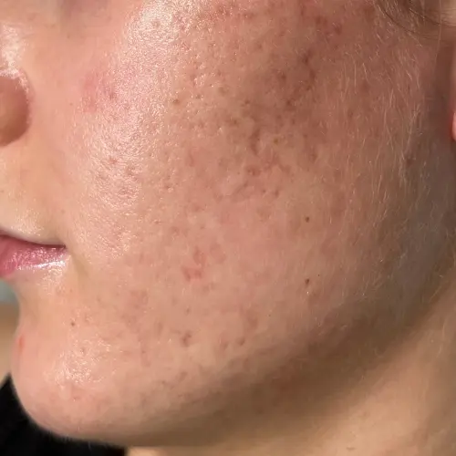 After acne treatment at The Vancouver Aesthetician — severe hormonal and gut health acne completely resolved and skin visibly clear and restored