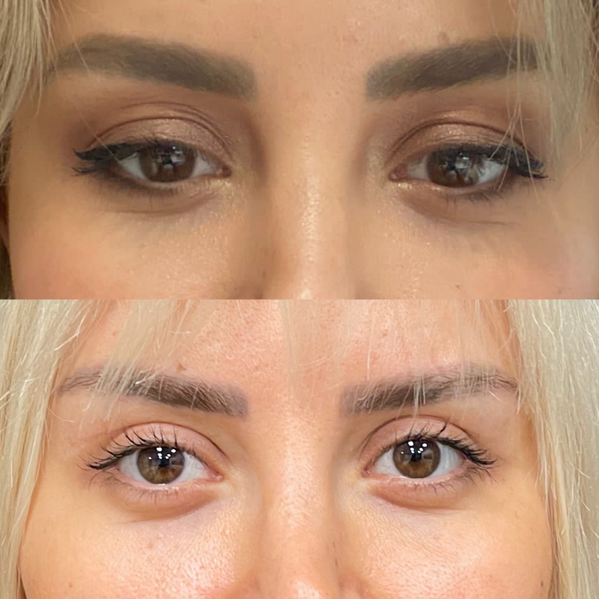 upper blepharoplasty before after 1 month