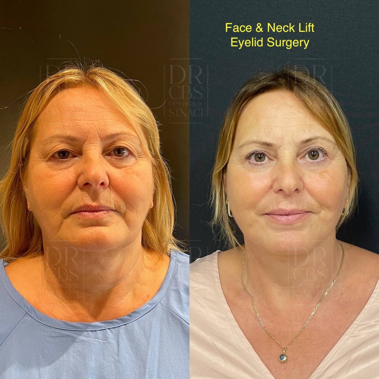 High SMAS facelift and upper blepharoplasty 5 months result before after front view