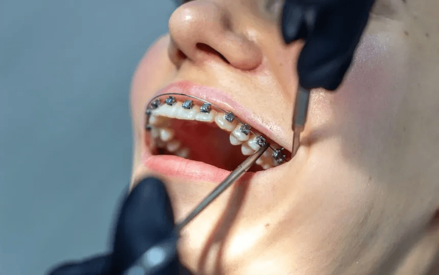 Self Ligating braces image