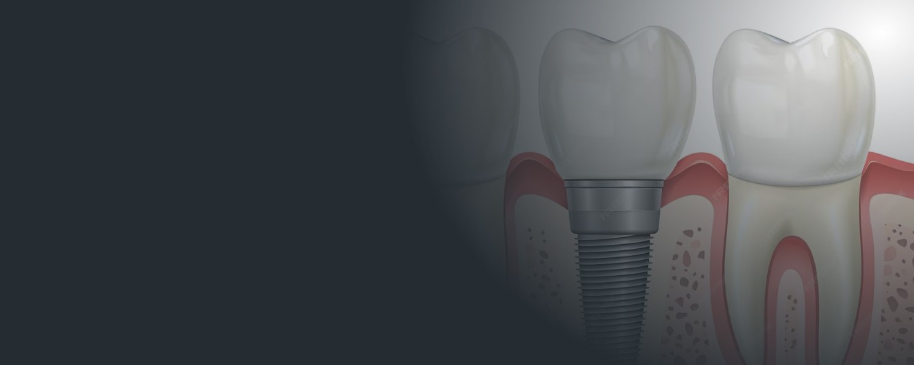 dental implant