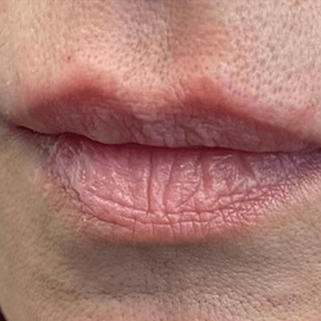 Dermal fillers after