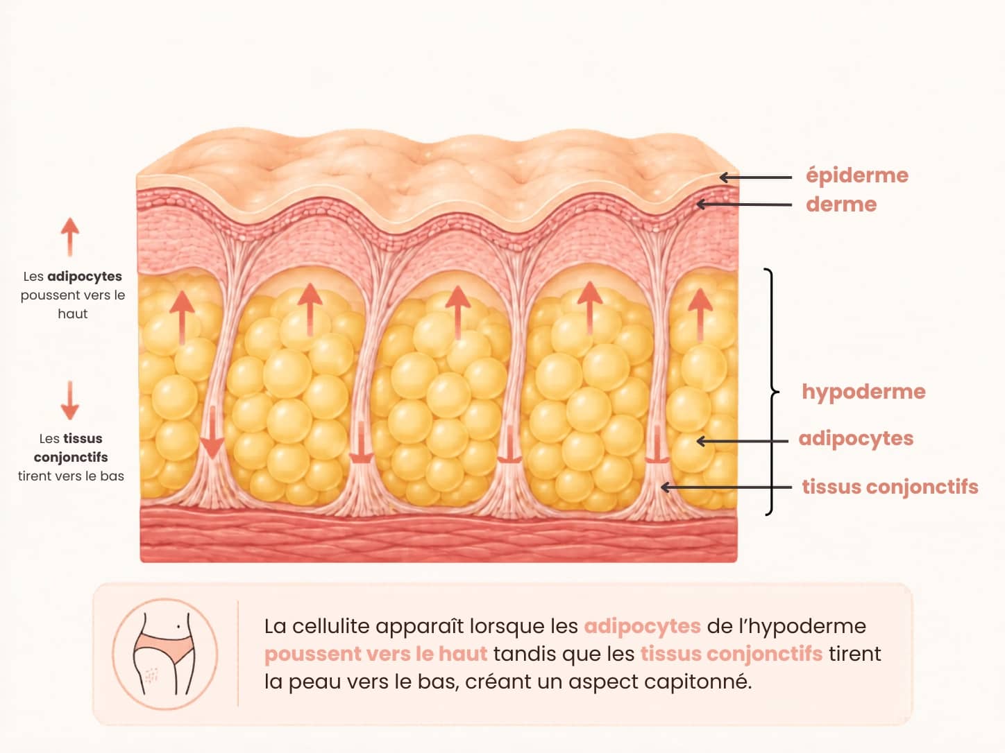 Schéma anatomique illustrant la formation de la cellulite : les cellules graisseuses de l'hypoderme poussent vers la surface de la peau, créant le fameux aspect peau d'orange souvent observé pendant la grossesse.