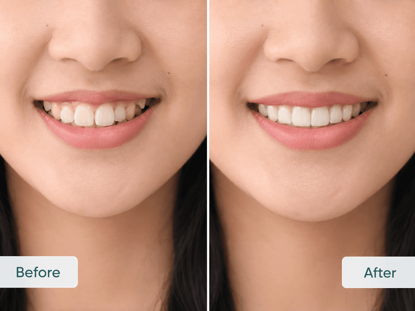 Sebelum dan Sesudah pemakaian Behel Metal