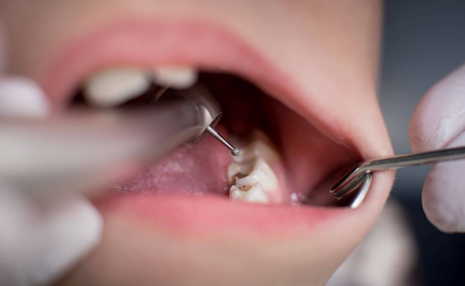 dental cavity treatment