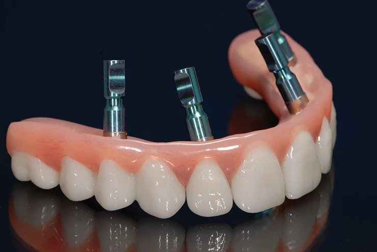 full mouth dental implants