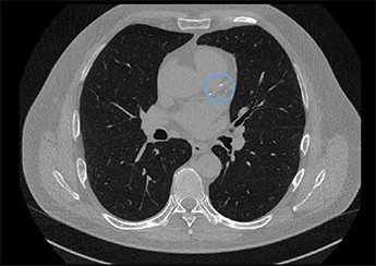 Calcium MRI scan image