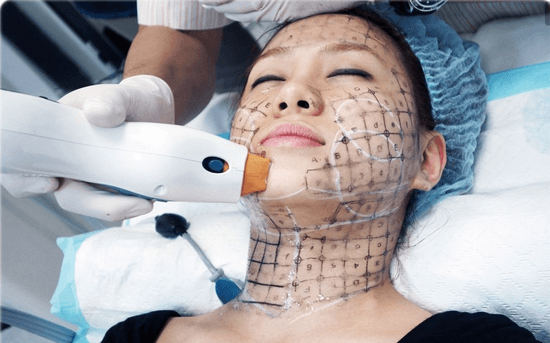 Woman receiving laser skin treatment with grid mapping on face