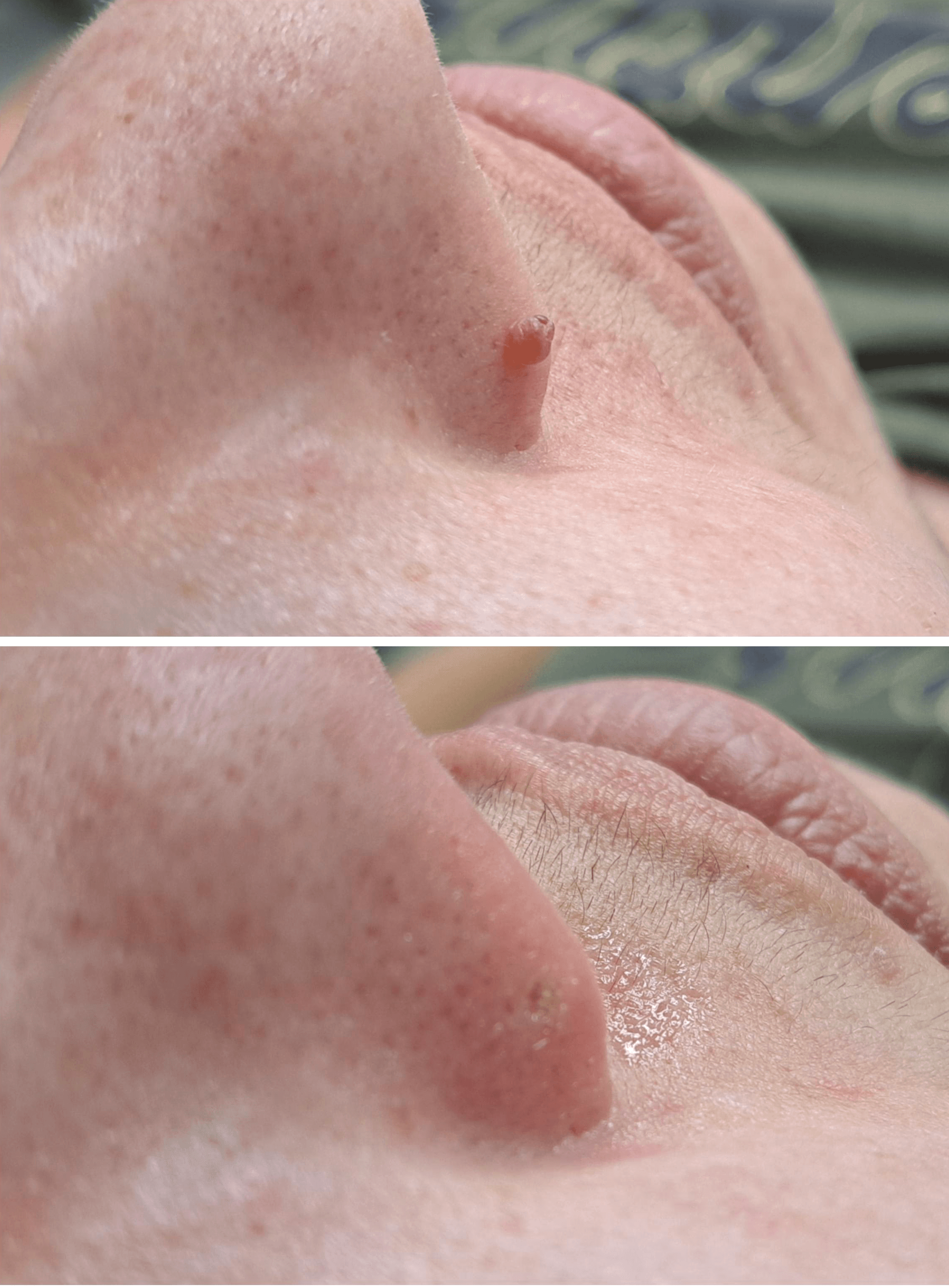Skin tag lam probe removal